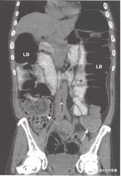 辨识肠梗阻,肠梗阻死亡前兆