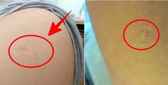 胳膊上的小圆疤是什么,每个人胳膊上的疤是怎么长出来的
