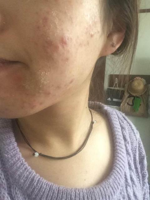 皇家雨燕教你痘痘肌の正确保养方式