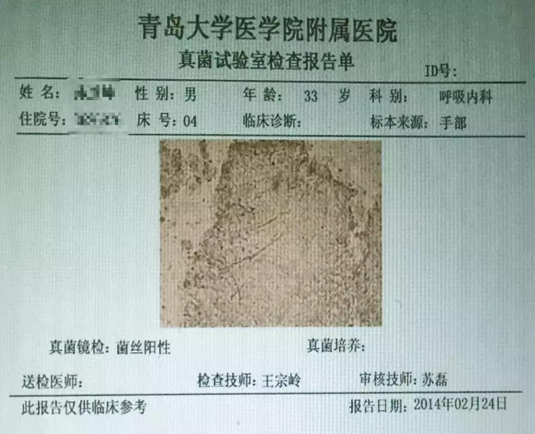 肺纤维化病例,肺纤维化手指甲发紫还能活多久