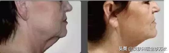 超声刀美容真的像张雨绮吗,张雨绮超声刀图片