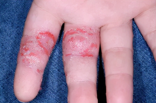 手上长脚气一样的水泡很痒怎么办,手上手臂起小水泡很痒是怎么回事