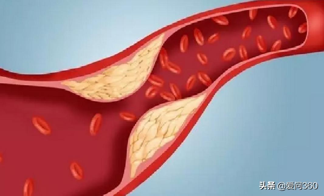 70岁老人血粘度低,老人血粘度偏高怎么调理