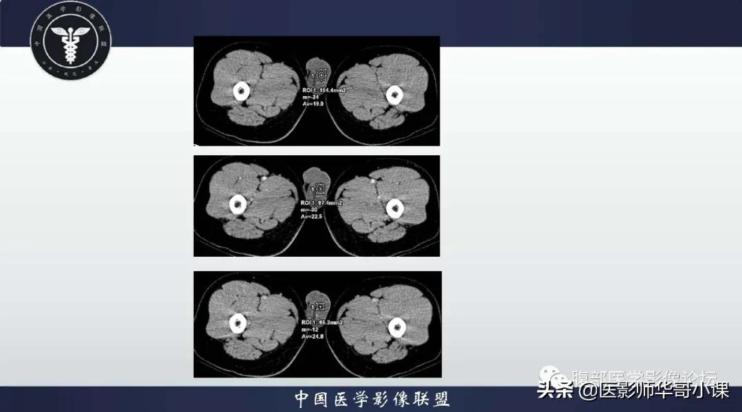 [精品课件]畸胎瘤及精原细胞瘤（*丸睾**肿瘤及肿瘤样变CT及MR表现）