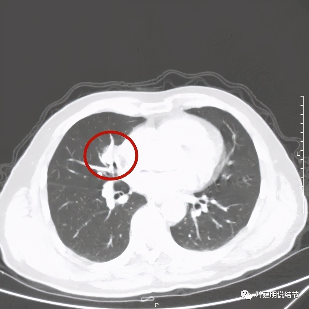 实性结节影要不要紧,实性结节穿刺活检为良性