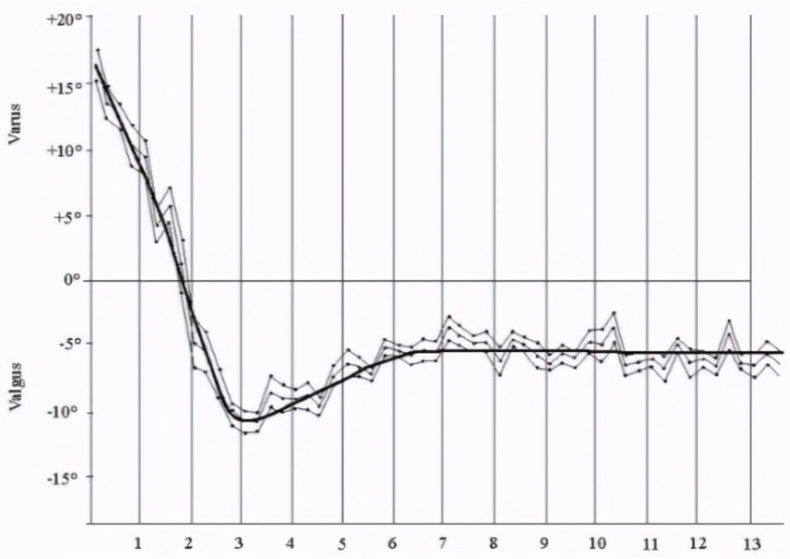 儿童肘内翻畸形,遗传右膝外翻畸形