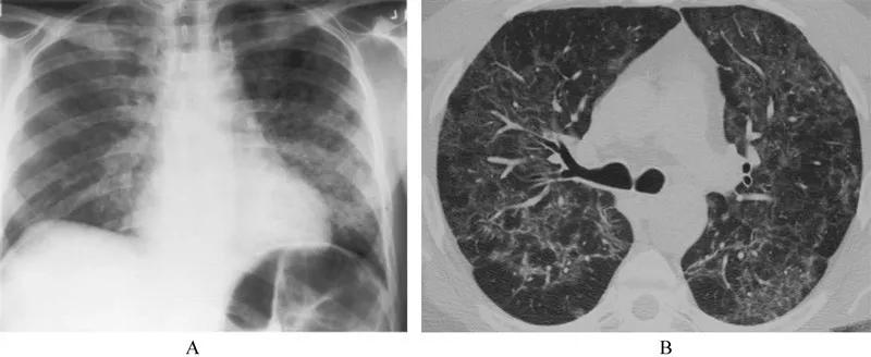 卡氏肺孢子菌感染症状,肺孢子菌是艾滋病感染的吗