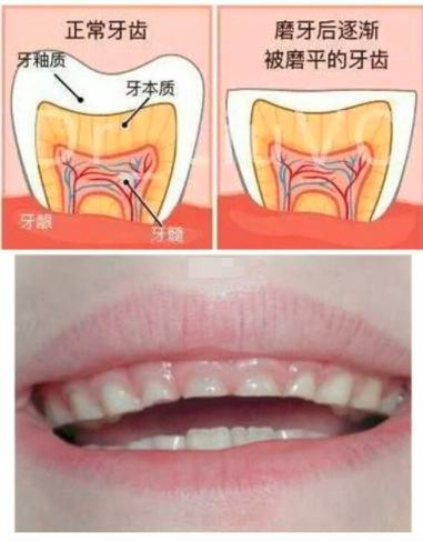 防止牙齿磨损的最佳方法,保留牙根的牙齿修复治疗