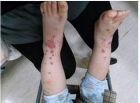 血液过敏性紫癜容易治疗么,妊娠合并血小板减少性紫癜表现