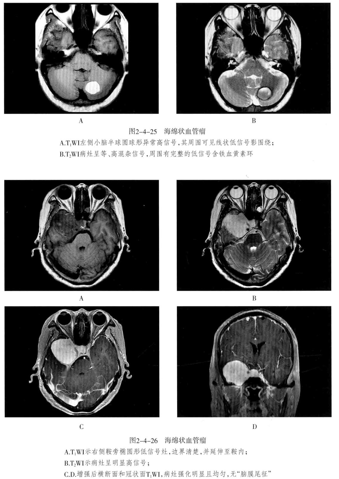 颅内血管轻度狭窄诊断标准,颅内血管先天变异影像