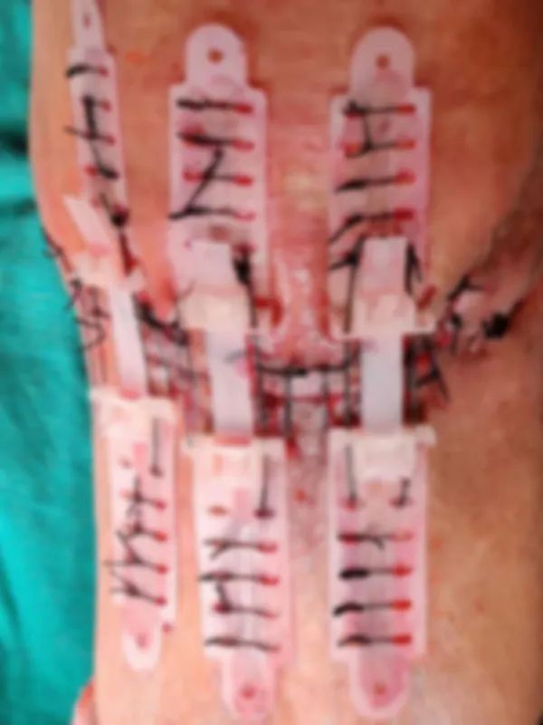 男士膝盖破了怎么办,膝关节破了个洞