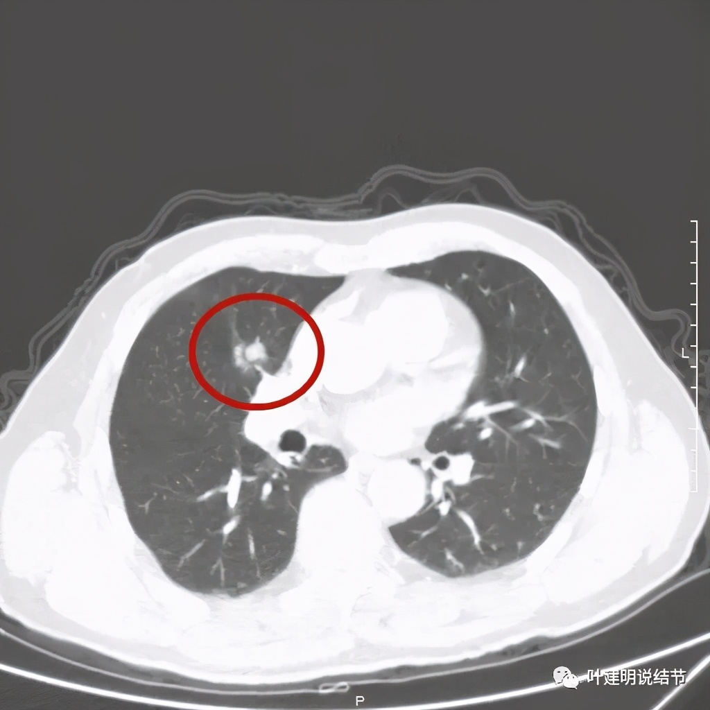 实性结节影要不要紧,实性结节穿刺活检为良性