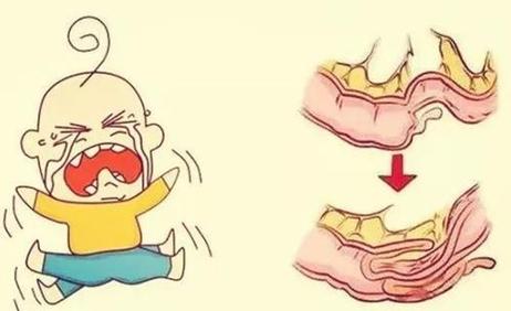 小儿梅克尔憩室炎不便血,蛋白质过敏宝宝便血