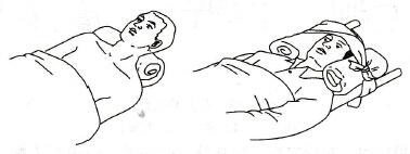 骨折后肿胀不能手术怎么办,骨折恢复过程中脚肿怎么办