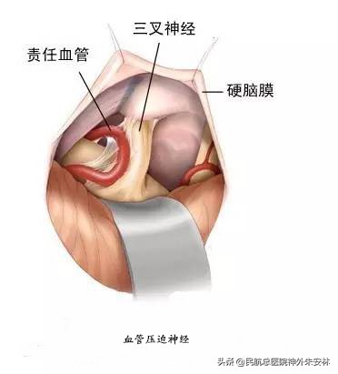 血管压迫三叉神经痛会痛一辈子吗,原发与继发三叉神经痛如何治疗