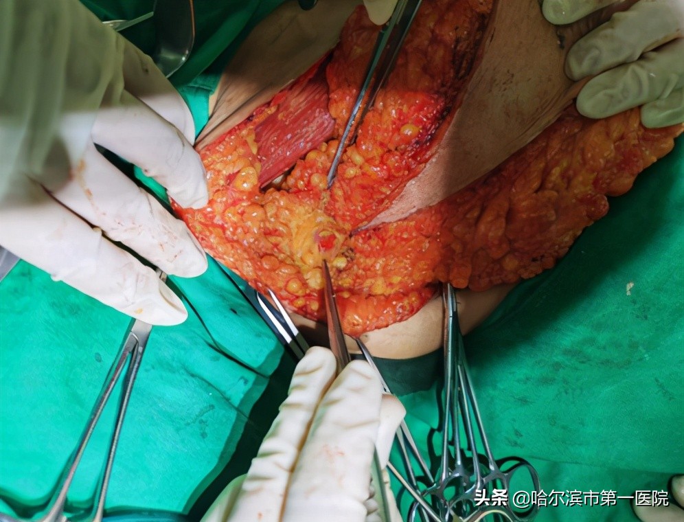 乳腺癌前哨淋巴结活检辅助手术,哈尔滨肿瘤医院做乳腺手术