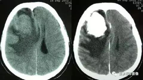 颅内有钙化怎么治疗,34岁脑部有钙化正常吗