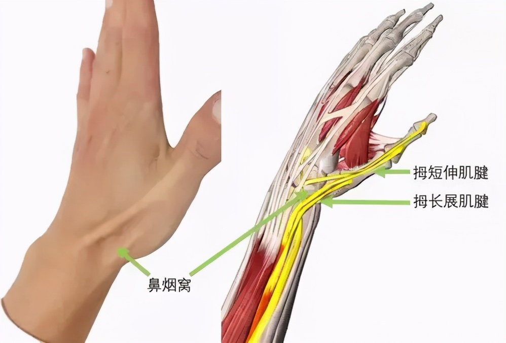 患了传说中的“妈妈手”怎么办，狭窄性腱鞘炎治疗看这里