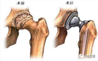 成人髋关节发育不良的锻炼方法,成人髋关节发育不良保守吃什么药