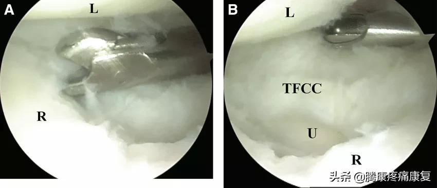 腕关节三角纤维软骨复合体损伤,三角纤维软骨损伤最佳治疗方法