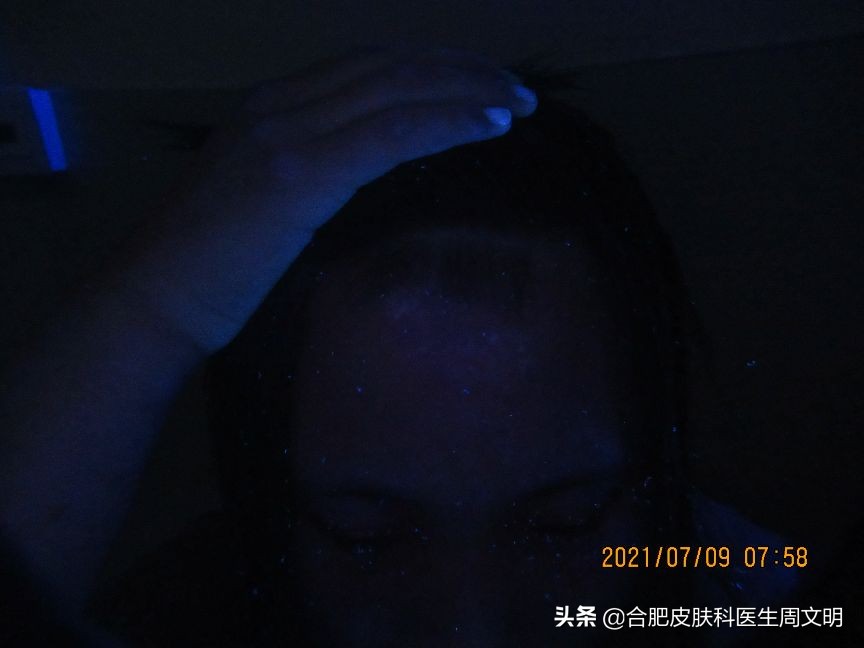 15岁女生误诊,15岁女孩染病竟有4年病史