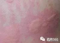 麻疹有什么中成药,常见人工荨麻疹的治疗方法有哪些