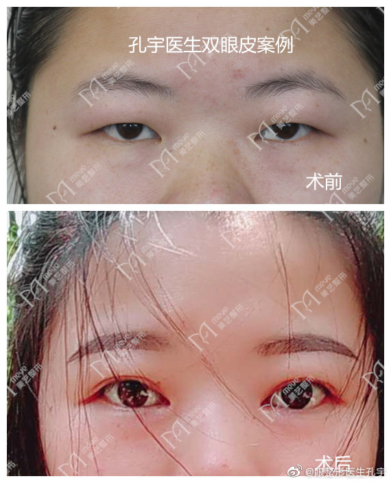 肿眼泡建议割双眼皮吗,肿眼泡做双眼皮怎样才会成功