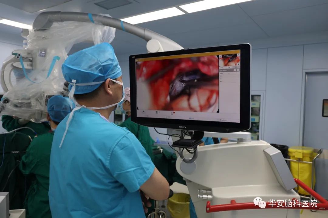 面神经显微血管减压手术,面肌痉挛显微减压术