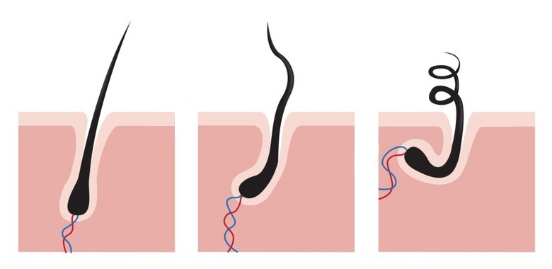 毛囊退化的原因和治疗方法,毛囊萎缩还能长出头发吗