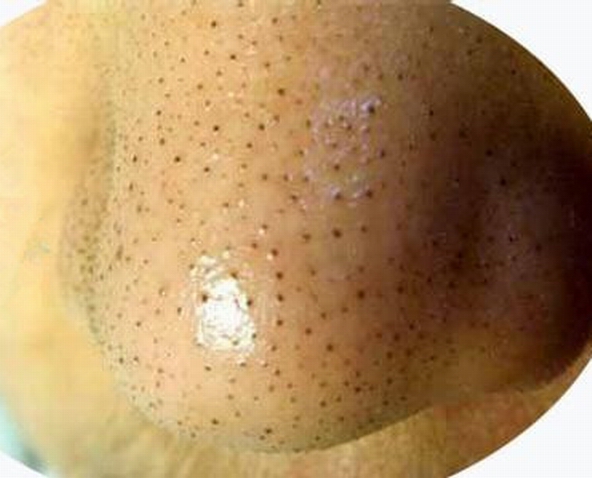 正确的去黑头方法是这样的,正确的去黑头方法