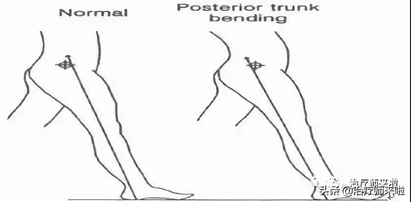 常见的异常步态醉酒步态,步态异常的十大特征有哪些图片