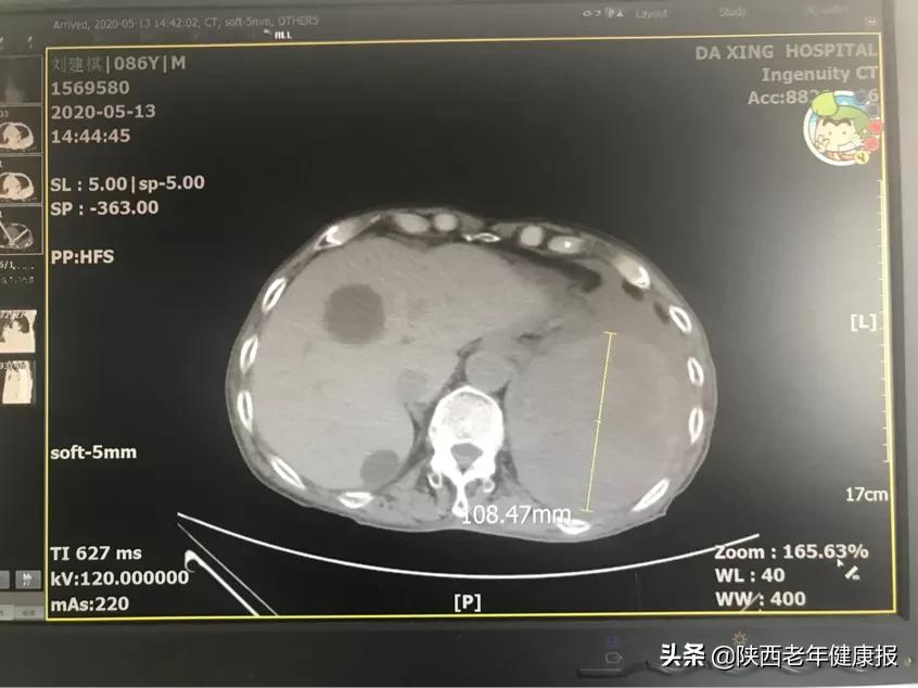 胸腔多出一个“心脏”，大兴多学科联合为高龄老人“摘心”祛疾