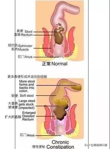 治疗慢性便秘,慢性便秘该如何治疗