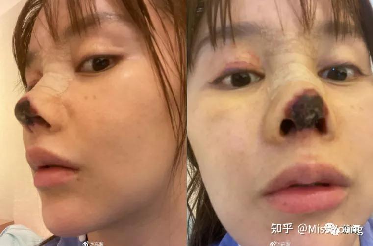 整容自毁前程的女明星,整容失去灵魂的女明星