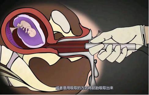 人工流产手术操作全过程是怎样的,人工流产手术全过程及危害