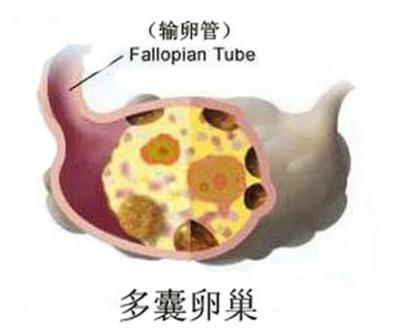 多囊可怕不,多囊其实不一定是坏事