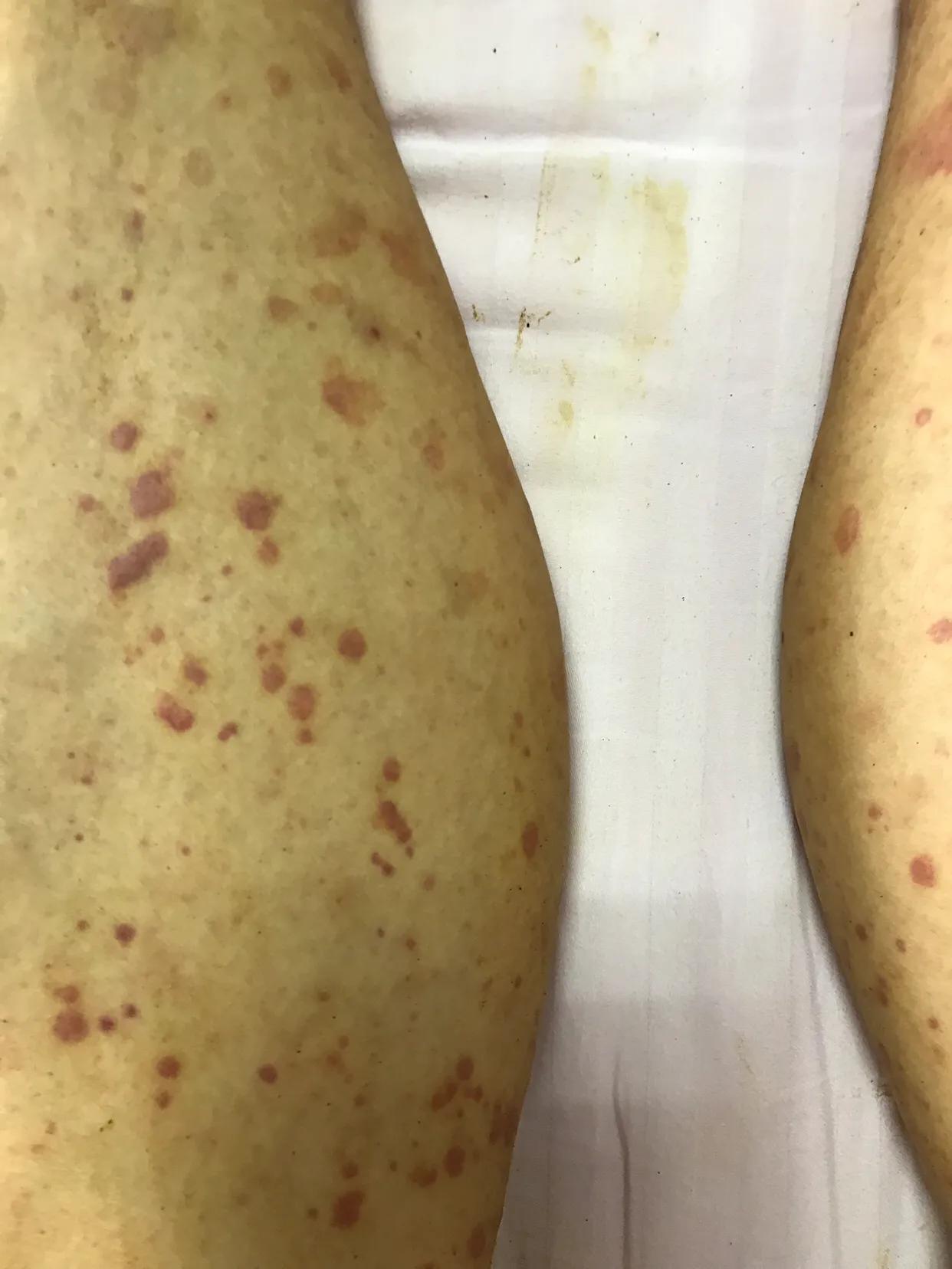 过敏性紫癜怎么治疗,过敏性紫癜