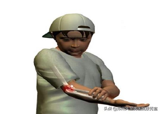 类风湿患者如何保护关节,类风湿如何日常保养