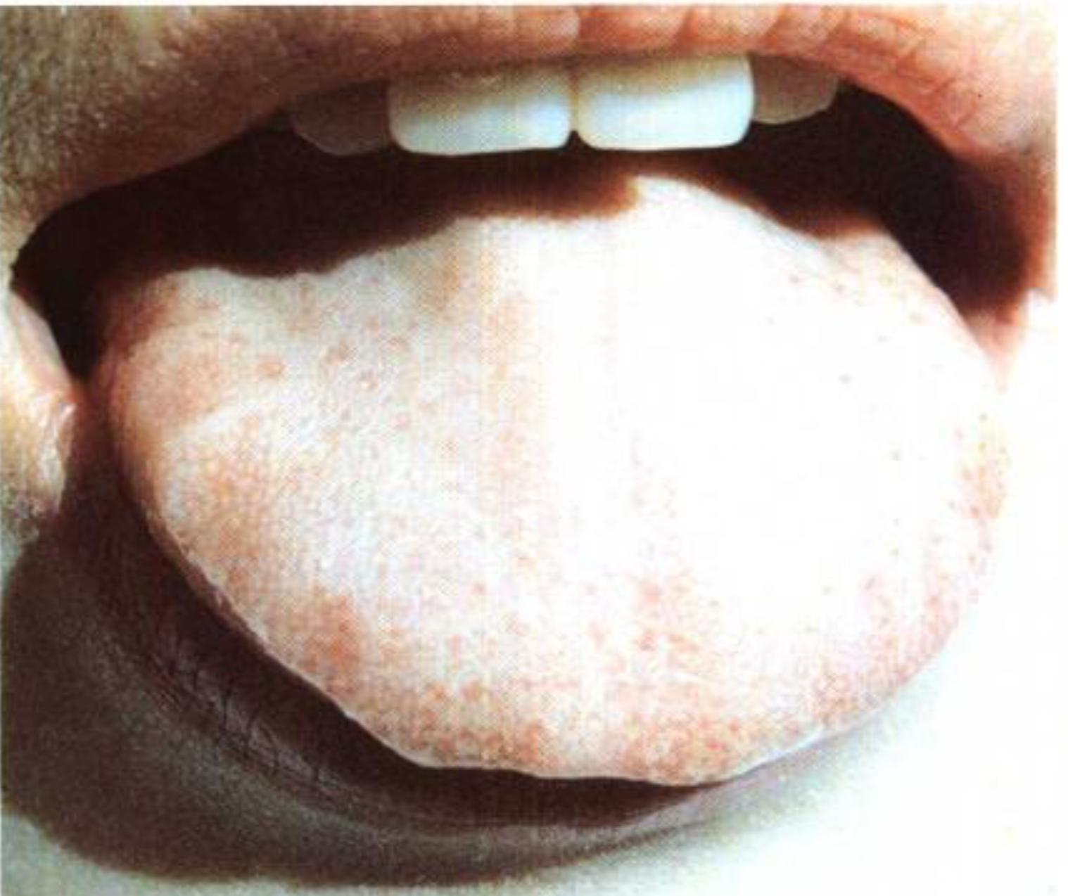 如何从舌苔判断健康,怎样通过舌苔颜色判断身体状况