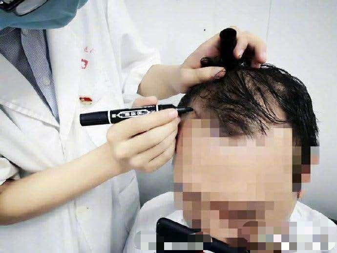 24岁男子健身险成秃头,24岁小伙疯狂健身后秃头