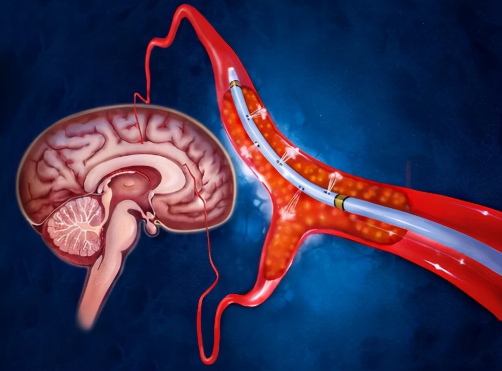 脑梗是“拖”出来的？脑梗来临前有哪些迹象？早知早受益