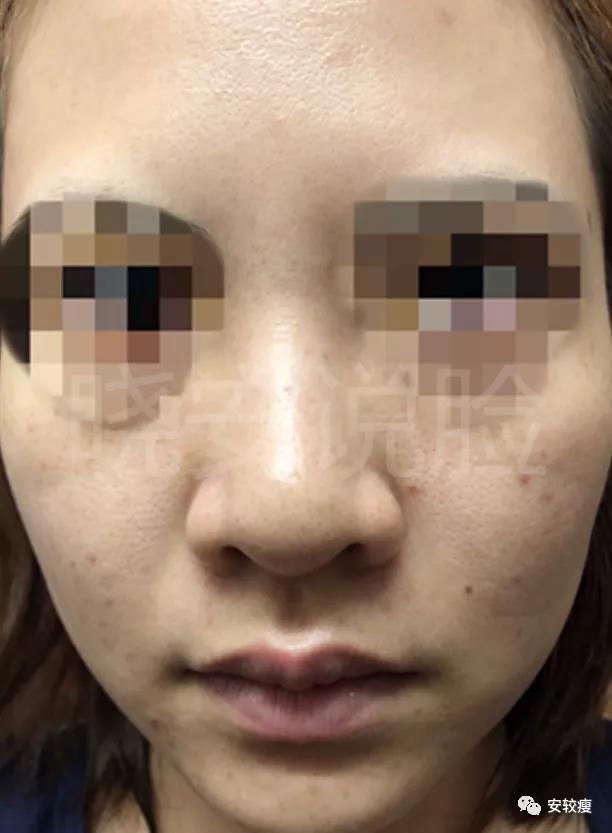 外油内干敏感痘肌怎么护肤,30岁油皮痘痘敏感肌怎么改善