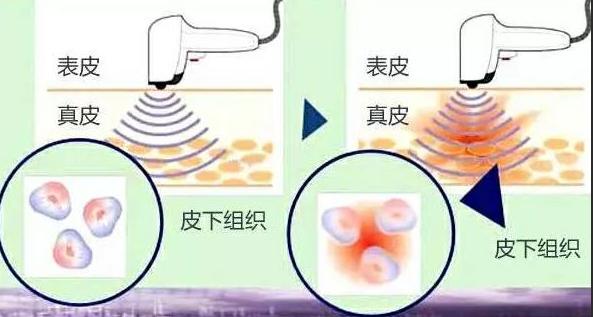 光子嫩肤脱毛仪的危害和禁忌,光子嫩肤注意事项文字