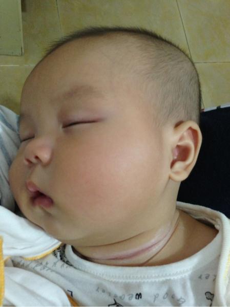 婴儿脖子有痱子和湿疹怎么处理,婴儿淹脖子可以擦痱子药膏吗