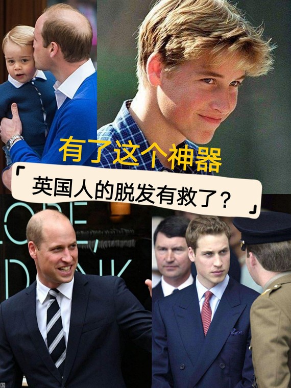 有了这个神器，英国人的脱发有救了？