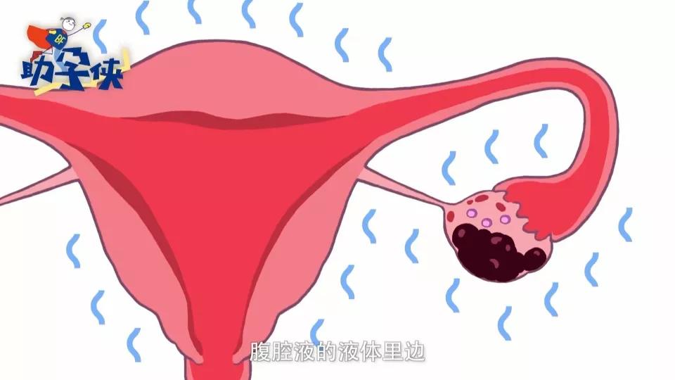 妇产科死亡率最高的癌,妇产科医生谈良性癌症