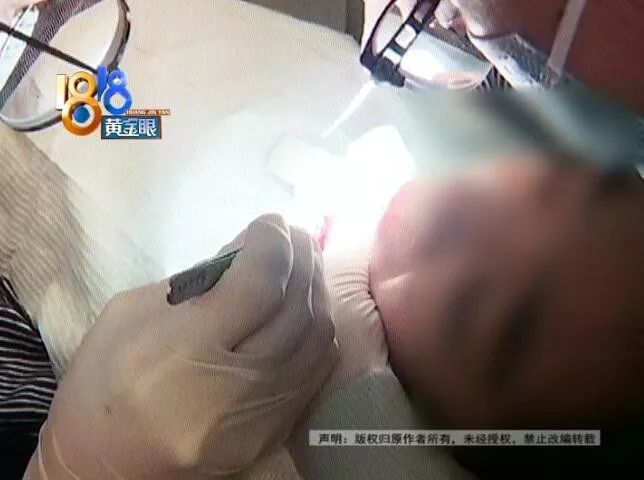 补牙把舌头下面划了一个洞,在小诊所补牙被扎舌头