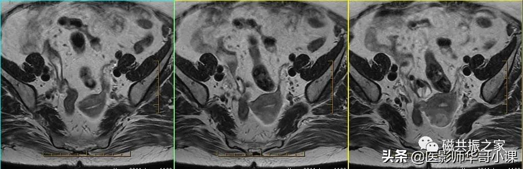「精品课件」带大家看看,磁共振子宫MRI要如何扫描?