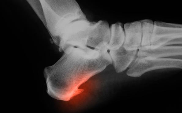 浏阳骨科医院治骨质增生吗,骨质增生查什么