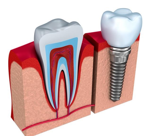 种植牙第一次拆线后的步骤,种植牙二期修复取模的步骤